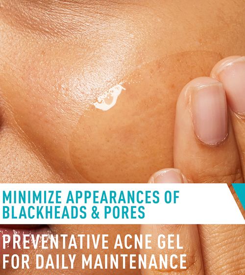 Acne Control Gel | For intense acne control
